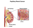 Targeted Therapy Cabozantinib Slows Progression of Rare Kidney Cancer; Cancer Currents Blog Featuring Dr. John Wright