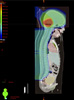 For Kids with Medulloblastoma, Trial Suggests Radiation Can Be Tailored; Cancer Currents Blog
