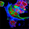Study Confirms Dinutuximab Extends Life for Children with High-Risk Neuroblastoma