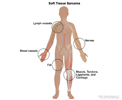 NCI Clinical Trial Leads to Atezolizumab Approval for Advanced Alveolar Soft Part Sarcoma